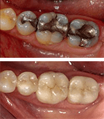  All-Porcelain Crowns at Our Everett Dental Office