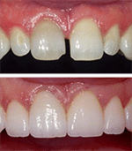 Porcelain Veneers at Our Everett Dentist Office