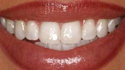 Teeth Whitening in Everett